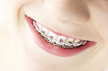 Braces in Hewlett