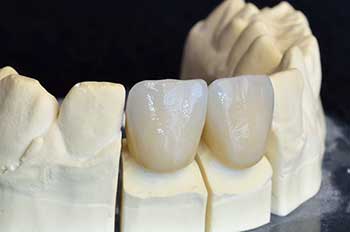 Dental Crowns Hewlett