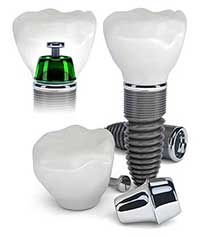 Hewlett Dental Implants