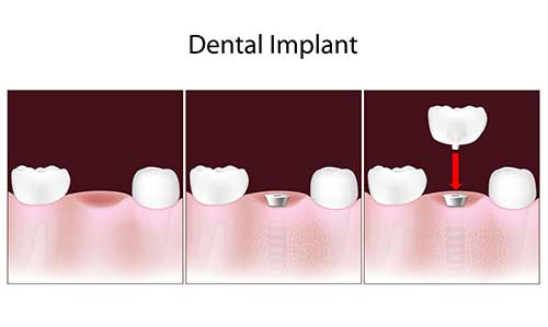 Implant Dentist in Hewlett