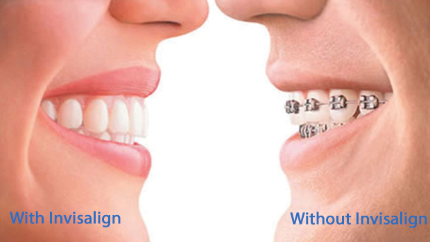 Invisalign in Hewlett