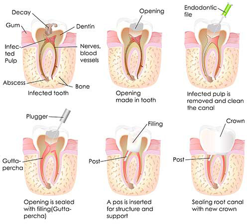 Root Canal Therapy in Hewlett
