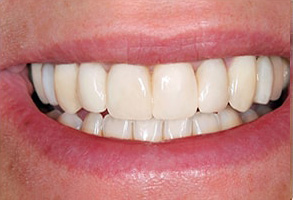 Hewlett Before and After Teeth Whitening