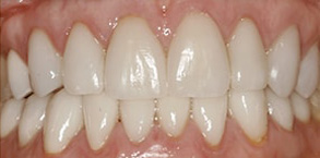 Hewlett Before and After Teeth Whitening