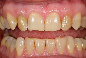 East Rockaway Before and After Dental Implants