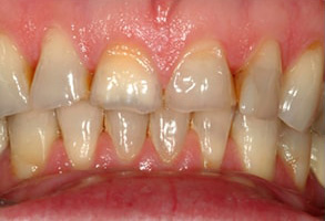 East Rockaway Before and After Dental Implants