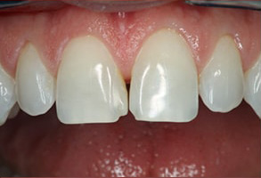 East Rockaway Before and After Dental Implants
